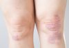 Psorijatični artritis – upalna bolest Psorijatični artritis