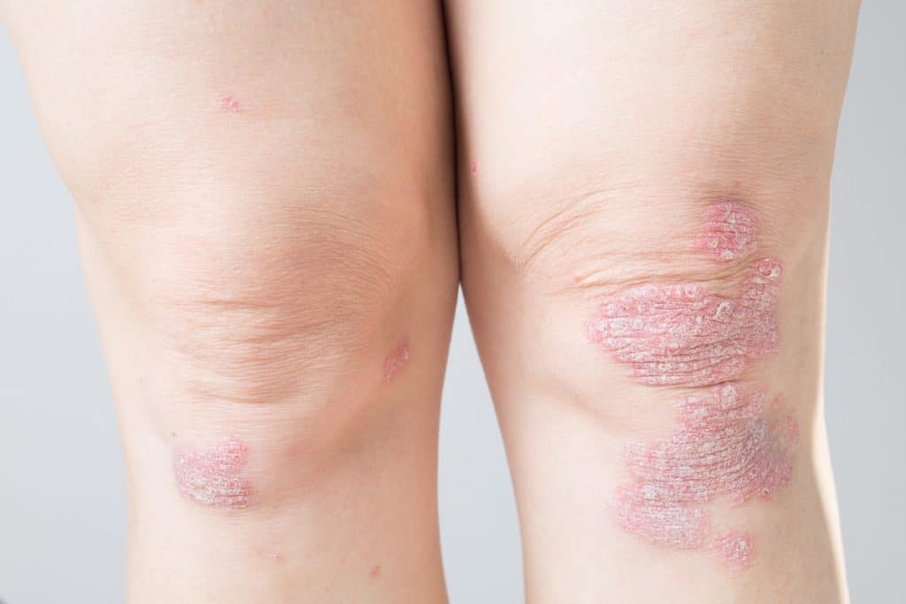 Psorijatični artritis
