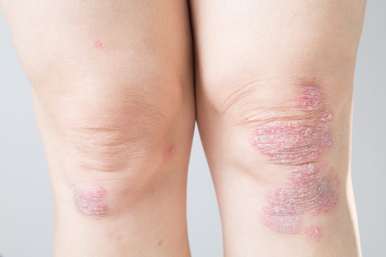 Psorijatični artritis – upalna bolest