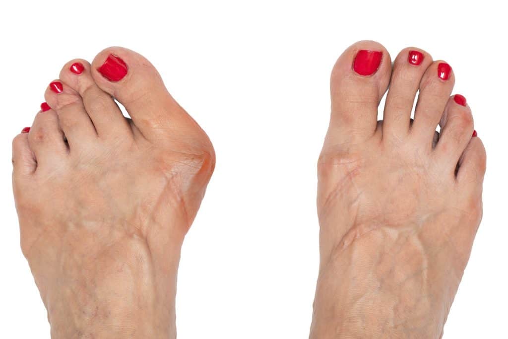 Hallux valgus