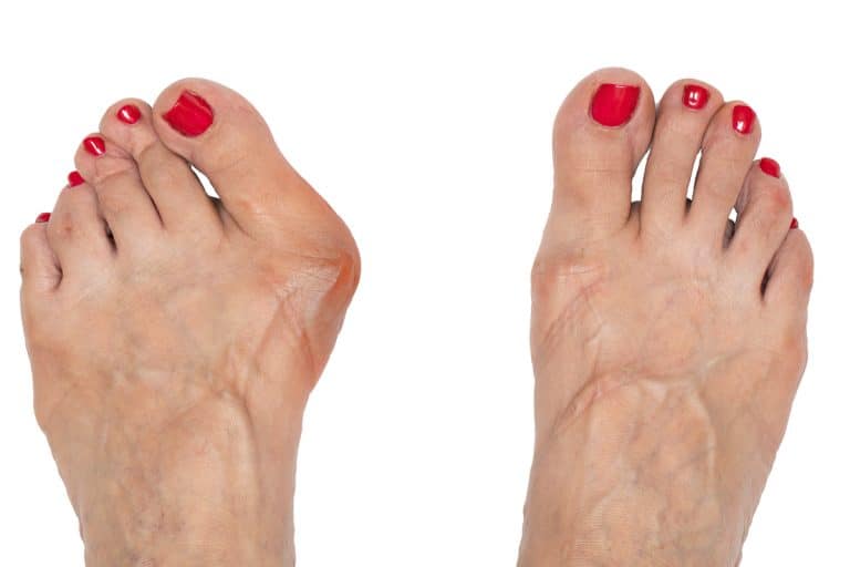 Hallux valgus deformacija palca na stopalu