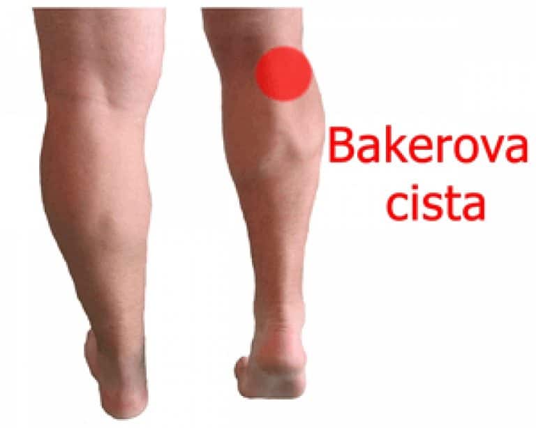 Bakerova (poplietalna) cista