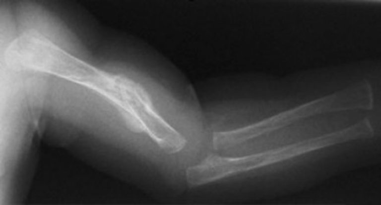 Osteogenesis imperfecta, bolest lomljivih kostiju