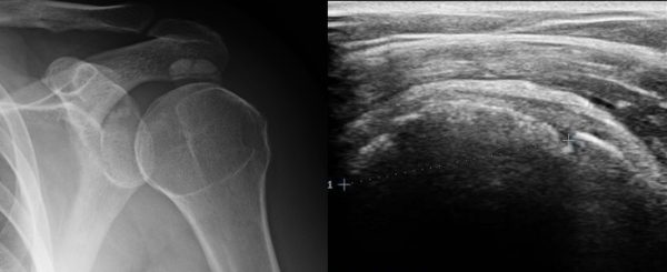 Kalcifikat u ramenu - kalcificirajuća tendinopatija - Portal o ...