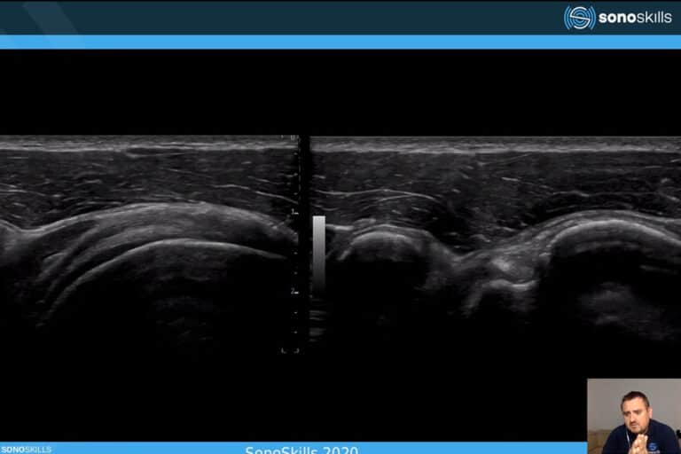 Održan webinar “Anatomija ramena prikazana MSK ultrazvukom”