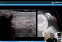 ODRŽAN WEBINAR “MSK ultrazvuk patelarne tetive” MSK ultrazvuk patelarne tetive
